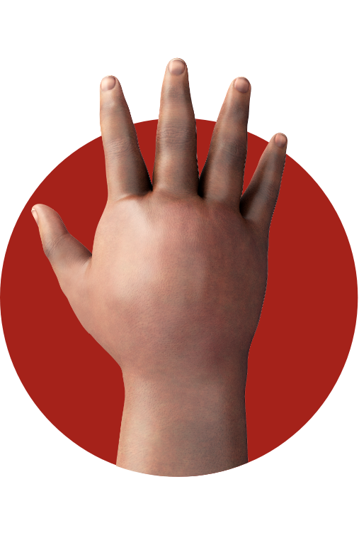 swelling hand